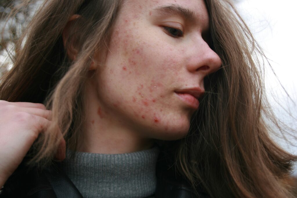 Acne Treatment Medical Research