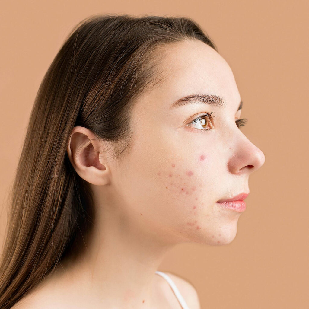 Clinical Trials in Acne Treatment